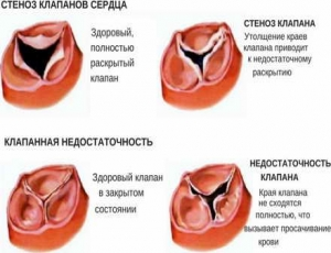 Порок сердца: что это, виды, симптомы, диагностика, лечение, профилактика